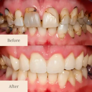 Limited-Time Pre-Sale⏰KLENIMORE™ Teeth Armor Drops