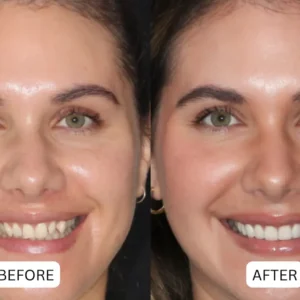 Limited-Time Pre-Sale⏰KLENIMORE™ Teeth Armor Drops