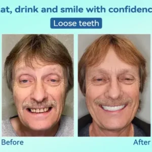 KLENIMORE® Premium Denture AdaptableFit Functional Dentures