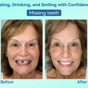 KLENIMORE® Premium Denture AdaptableFit Functional Dentures