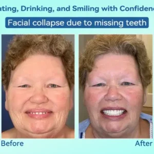 KLENIMORE® Premium Denture AdaptableFit Functional Dentures