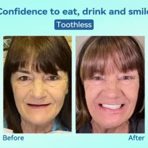 KLENIMORE® Premium Denture AdaptableFit Functional Dentures