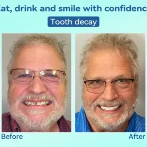 KLENIMORE® Premium Denture AdaptableFit Functional Dentures