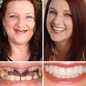 ⏰ Ends Today: 70% OFF! KLENIMORE™ Natural Smile Upgrade