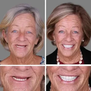 ⏰ Ends Today: 70% OFF! KLENIMORE™ Natural Smile Upgrade