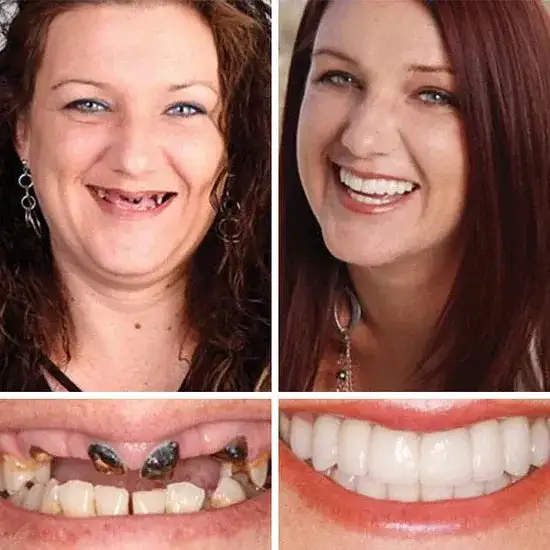 ⏰Ends Today: 70% OFF! 🌎KLENIMORE™ Custom-Fit Dentures— Designed for Comfort and a Natural-Looking Smile