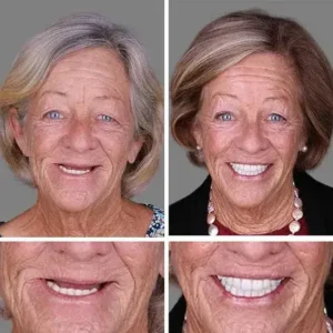 ⏰Ends Today: 70% OFF! 🌎KLENIMORE™ Custom-Fit Dentures— Designed for Comfort and a Natural-Looking Smile