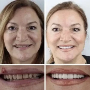 KLENIMORE™ Premium Denture 2026 | Custom-Fit Dentures
