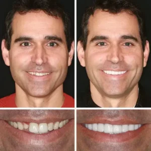 KLENIMORE™ Premium Denture 2026 | Custom-Fit Dentures