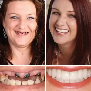 KLENIMORE™ Premium Denture 2026 | Custom-Fit Dentures
