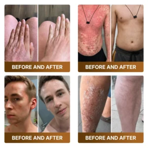 【Made and Shipped from US】🏥  KLENIMORE™ Botox & Bee Venom Advanced Recovery Cream—For Wrinkles, Sagging Skin, Skin Tags & Rough Bumps⚡