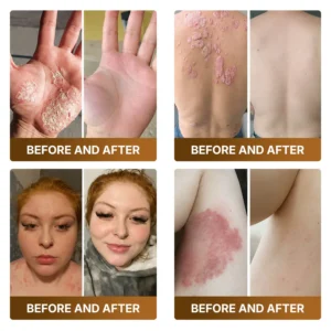 【Made and Shipped from US】🏥  KLENIMORE™ Botox & Bee Venom Advanced Recovery Cream—For Wrinkles, Sagging Skin, Skin Tags & Rough Bumps⚡