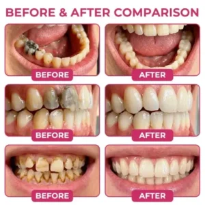 KLENIMORE DenPerm Cavity-Repair Natural Enamel Filling Gel
