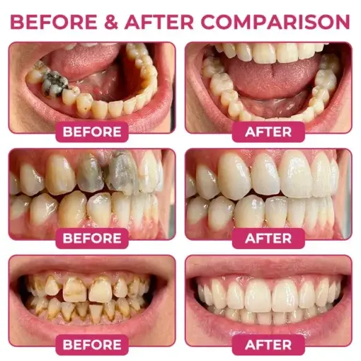 KLENIMORE DenPerm Cavity-Repair Natural Enamel Filling Gel